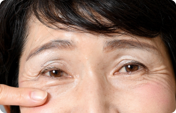ボトックス_目元のしわ