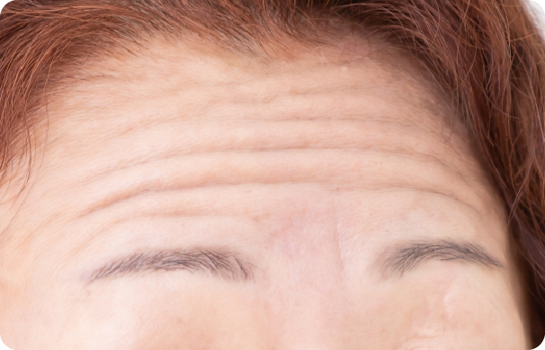 ボトックス_眉間のしわ