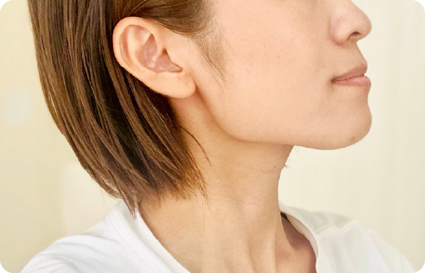 ボトックス_エラ張り