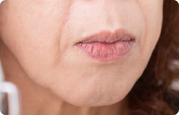 ボトックス_口角のたるみ