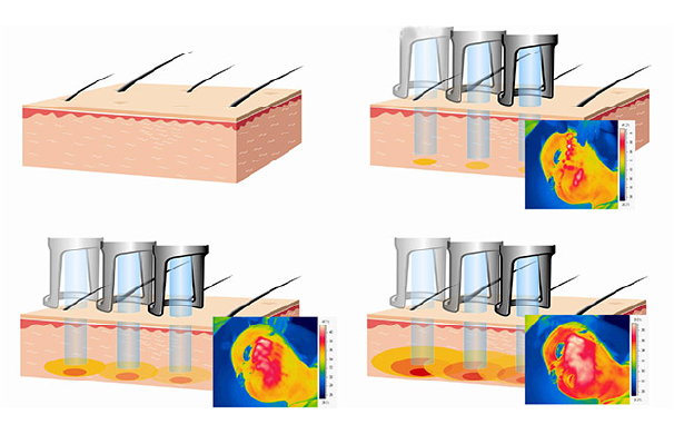 クラリティ脱毛_ポイント