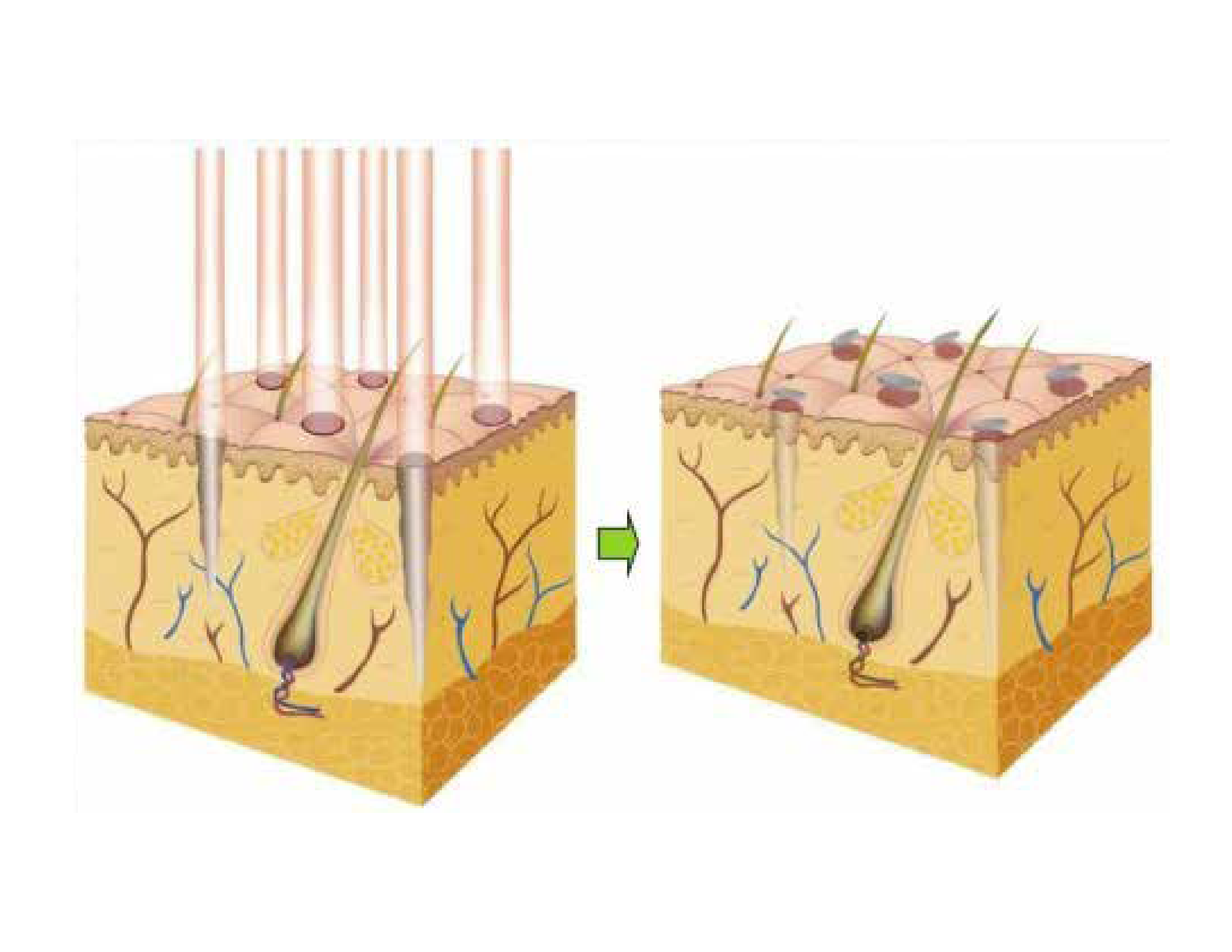 CO2レーザーによる施術の特徴