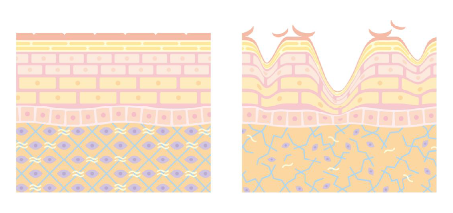 hifu_SMAS層まで届くリフトアップ効果説明