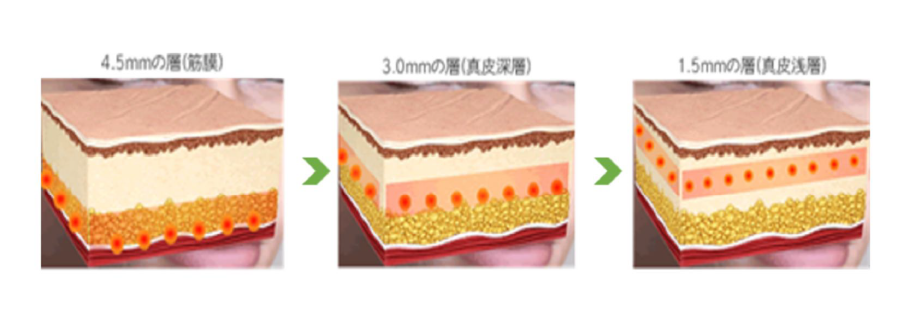 hifu_ダウンタイムの少ない快適設計